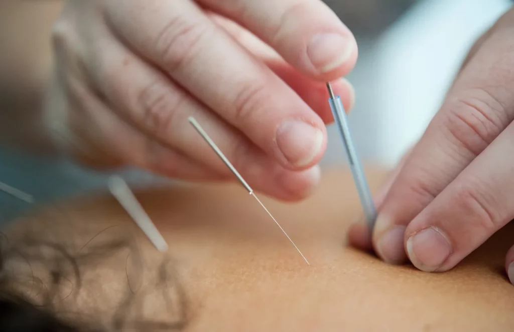 Was nach der Akupunktur zu erwarten ist Von Hochgefuehl bis hin zur voruebergehenden Verschlechterung